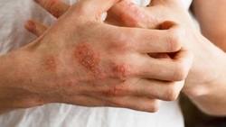 مواد طبیعی برای درمان عفونت‌های پوستی