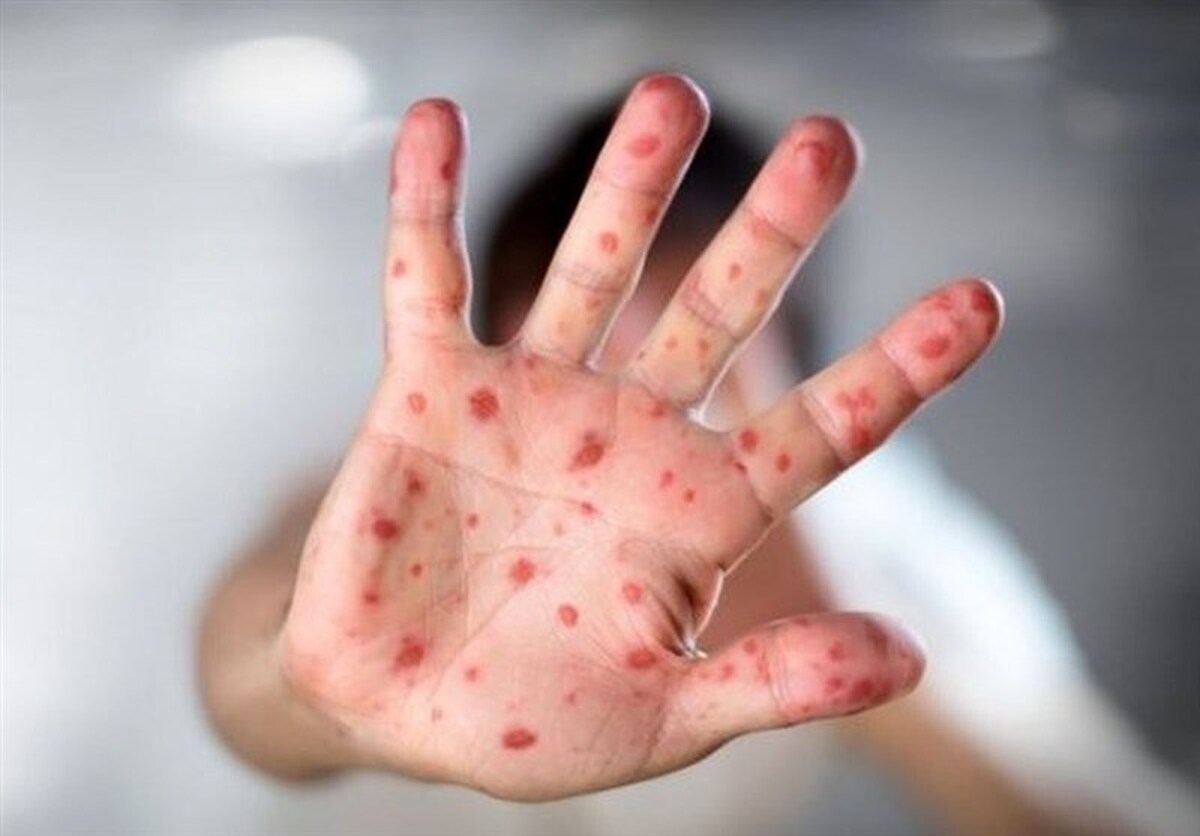 رشد بی‌سابقه آمار ابتلا به سرخک در آمریکا
