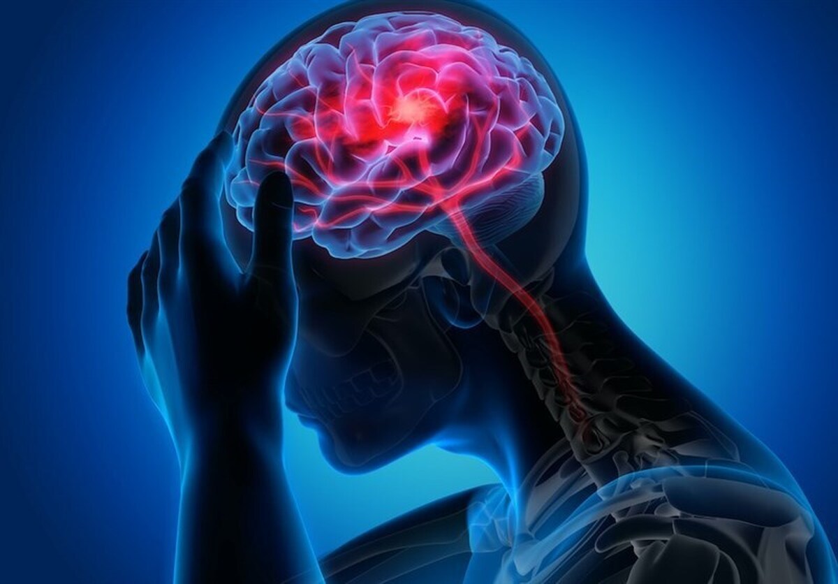 ابتلای ۱.۴ میلیون ایرانی به صرع/ میگرن شایعترین نوع سردرد