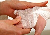 بستری سالانه ۳۰ هزار نفر بر اثر سوختگی در کشور/ باور‌های غلط مانع درمان به موقع بیماران